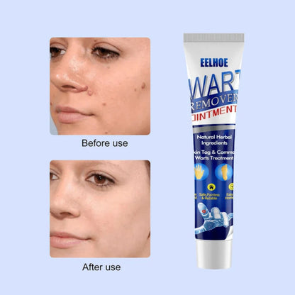 EELHOE Wart Remover Ointment Fast Acting Skin Tag & Wart Treatment (20g)
